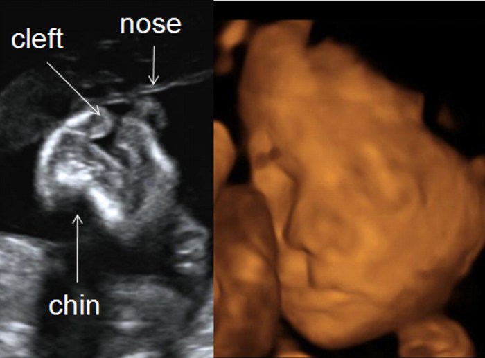 Cleft lip and cleft palate hesi case study