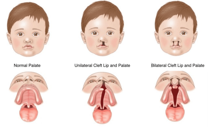 Cleft lip and cleft palate hesi case study